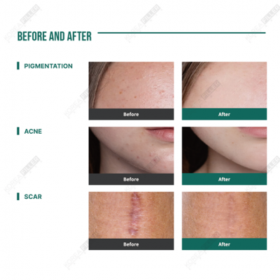 Exoluma – 1 Box (5 Sets) - Image 8